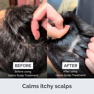 Before and after comparison of a scalp with Detox Scalp Treatment showing calmed itchy scalps.
